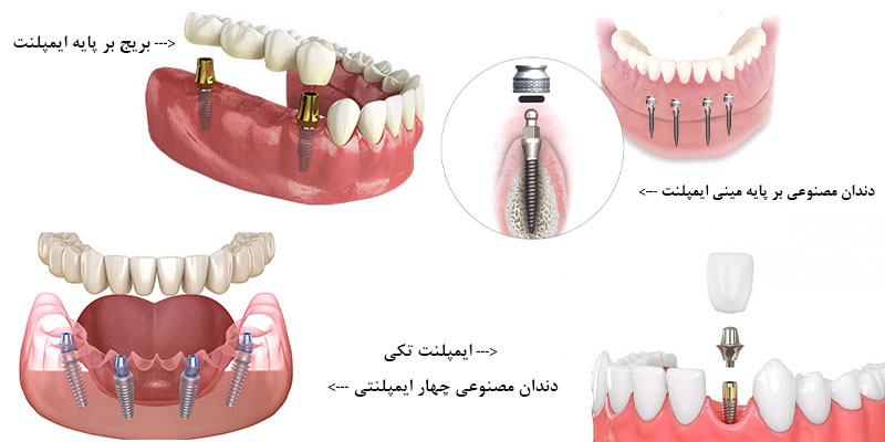 انواع پایه ایمپلنت کدامند 