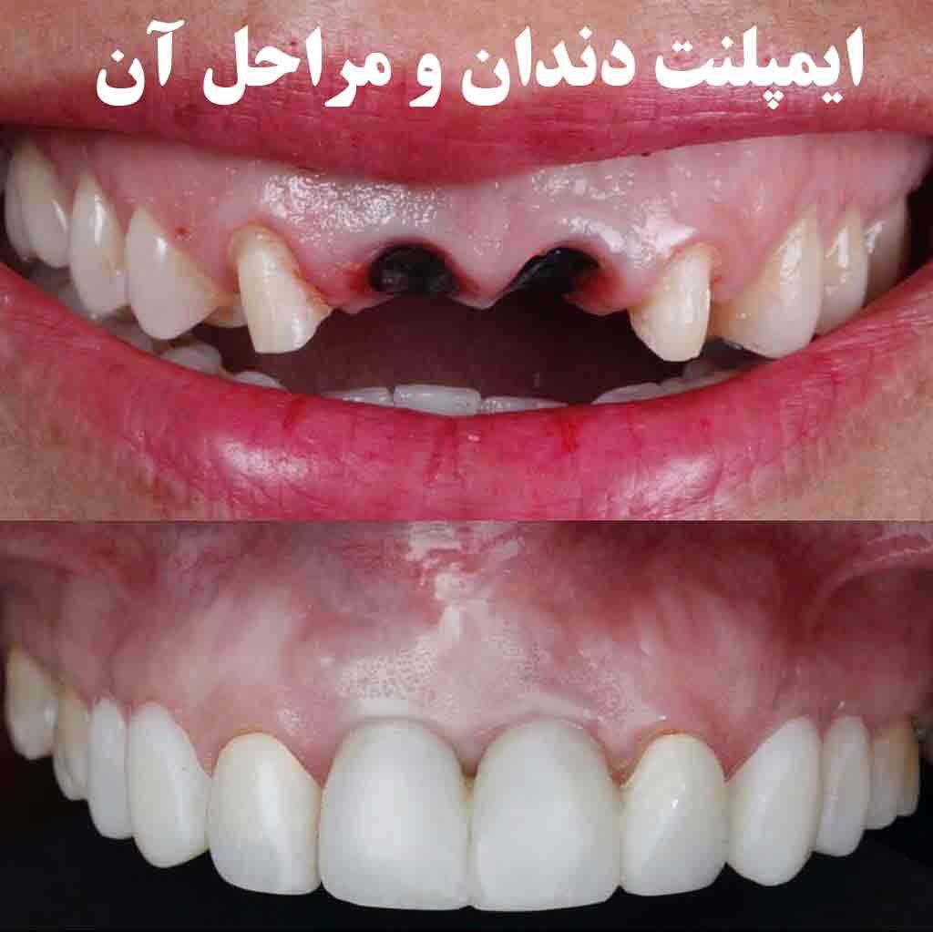 ایمپلنت دندان چگونه انجام میشود