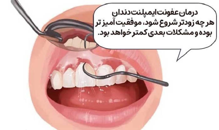 عفونت ایمپلنت دندان چگونه درمان میشود