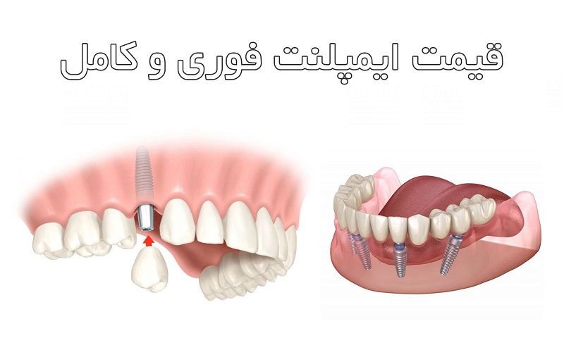 هزینه انجام ایمپلنت دندان فوری