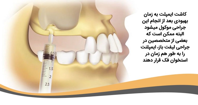 مراحل انجام سینوس لیفت فک