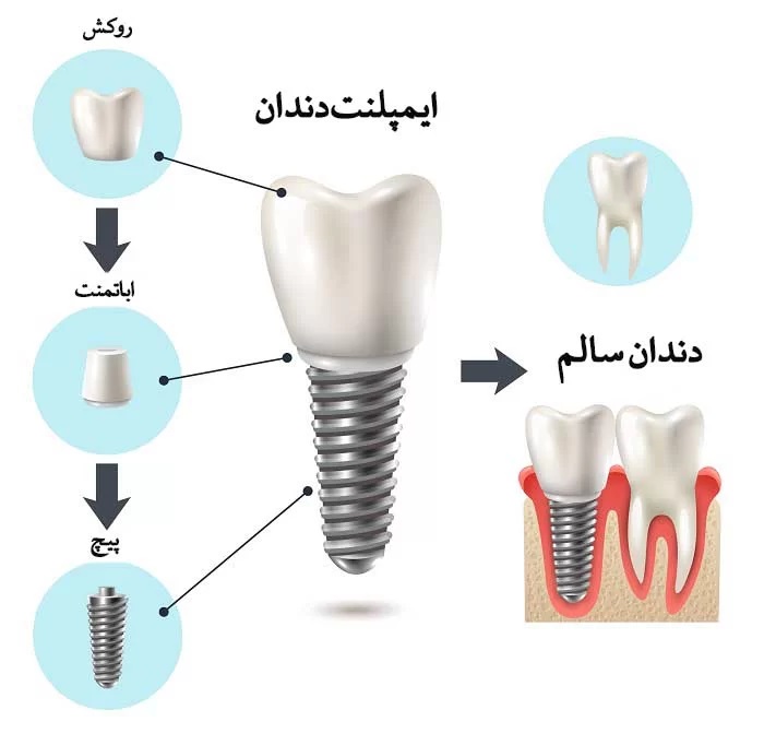 ایمپلنت دندان چه مزایایی دارد