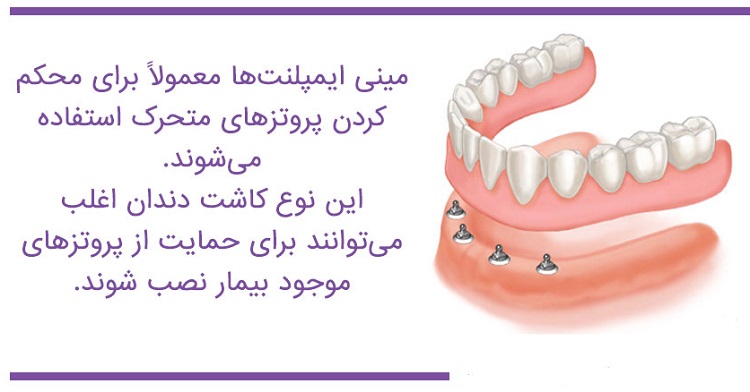 مینی ایمپلنت دندان چه مزایایی دارد