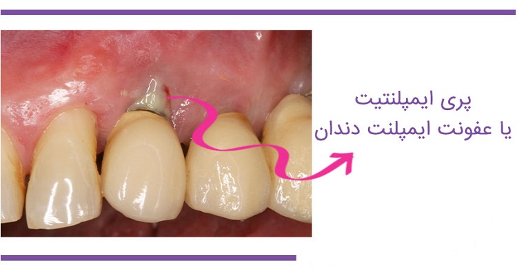 درمان پری ایمپلنت