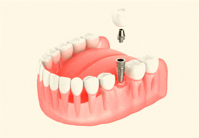 ایمپلنت ارزان در تهران با بهترین کیفیت