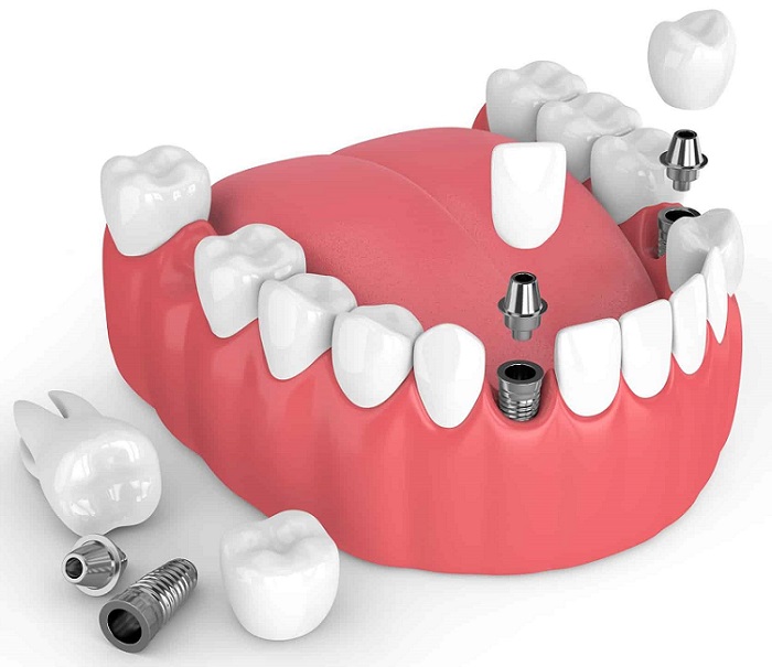 ایمپلنت کامل دهان چه مزایایی دارد