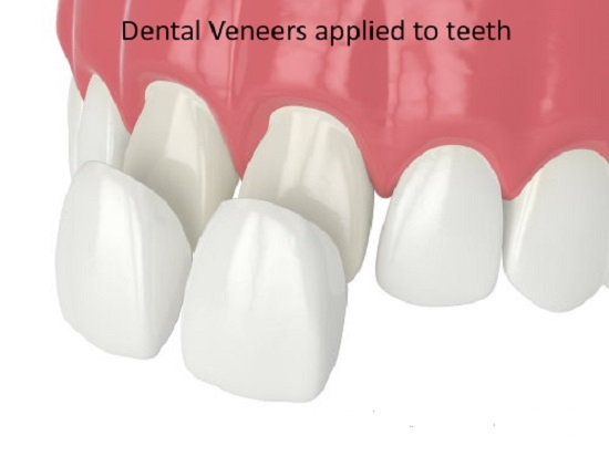 قیمت ونیر دندان چقدر است
