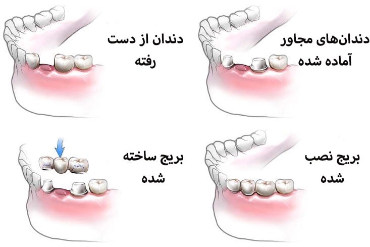 مراحل نصب بریج دندان چگونه انجام میشود