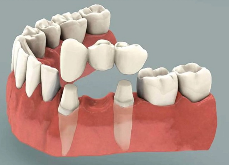 بریج دندان چه مزایایی دارد
