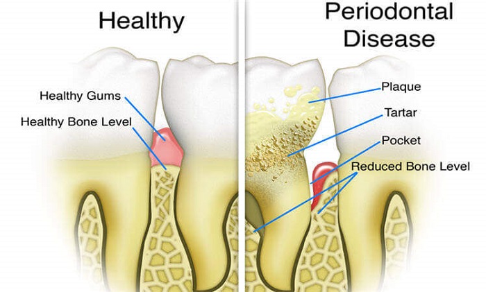 التهاب یا بیماری لثه چگونه ایجاد میشود