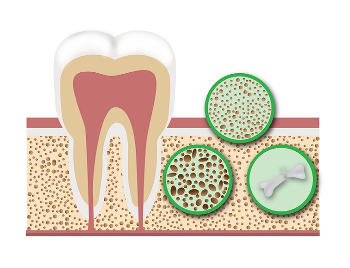 بیماری‌ استخوانی و تاثیر آن بر سلامت دهان و دندان