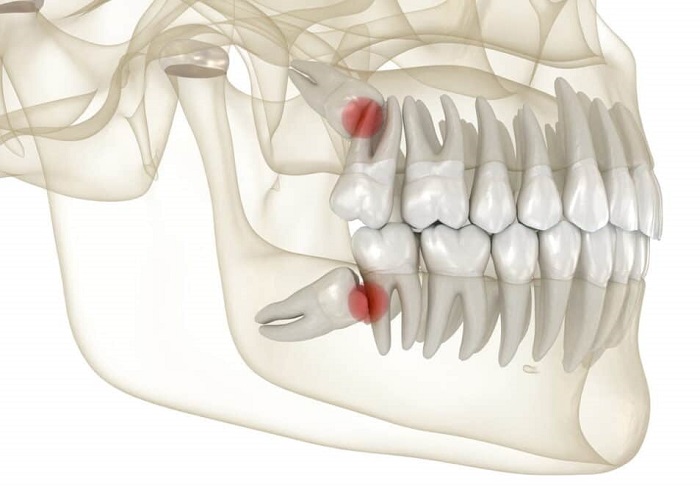 دندان عقل چیست و چگونه درمان میشود