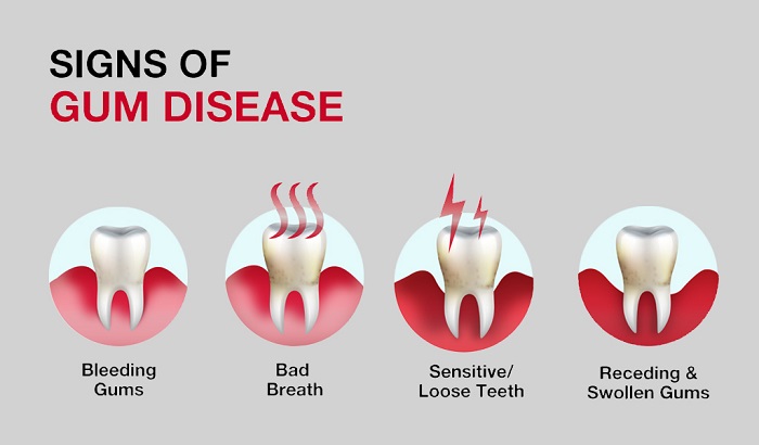 علائم بیماری های لثه کدامند