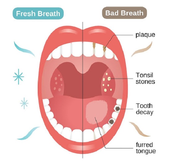 بوی بد دهان چه علائمی دارد