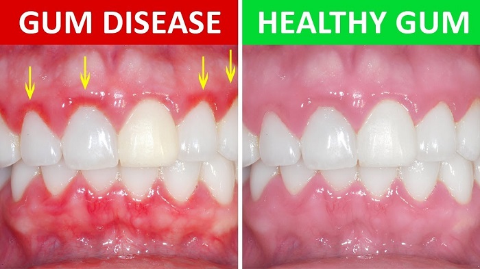 معانی رنگهای متخلف لثه چیست