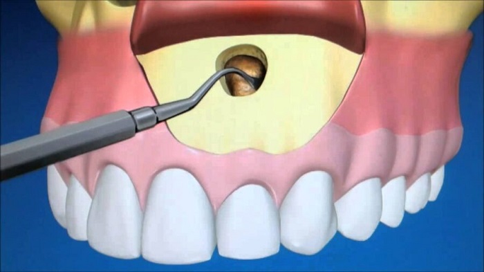 چه افرادی نیاز به جراحی اپیکو دندان دارند و چگونه است