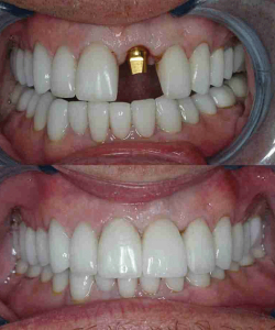 retained-before-after