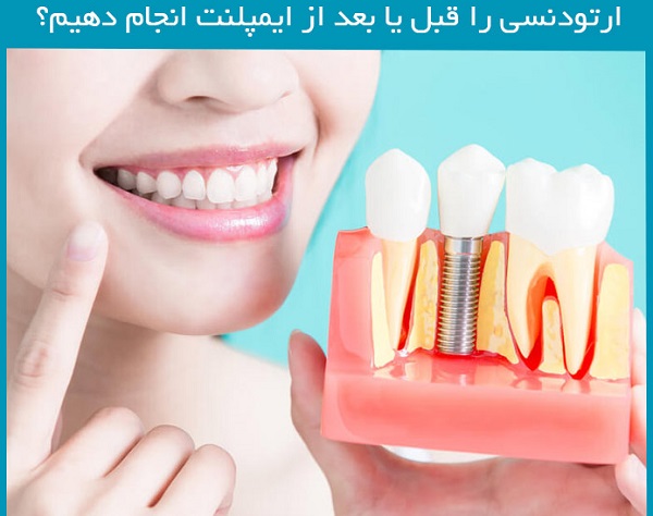 ارتودنسی و ایمپلنت دندان چگونه است