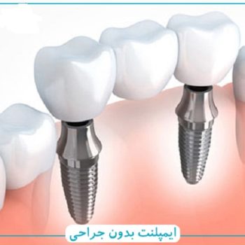 انواع روش های ایمپلنت بدون جراحی