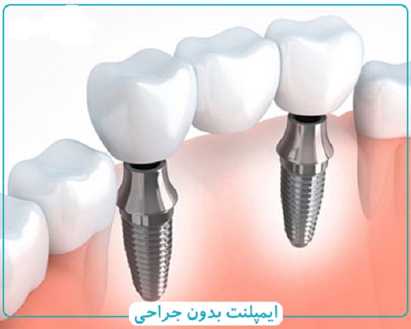 انواع روش های ایمپلنت بدون جراحی