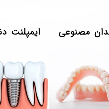 ایمپلنت دندان با دندان مصنوعی چه تفاوتی دارد