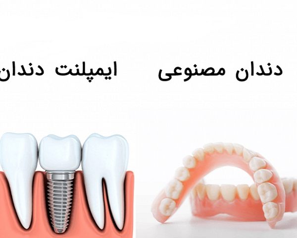 ایمپلنت دندان با دندان مصنوعی چه تفاوتی دارد