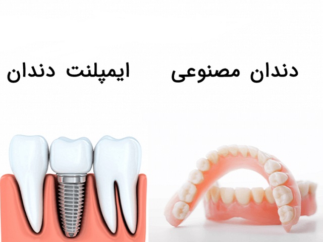 ایمپلنت دندان با دندان مصنوعی چه تفاوتی دارد