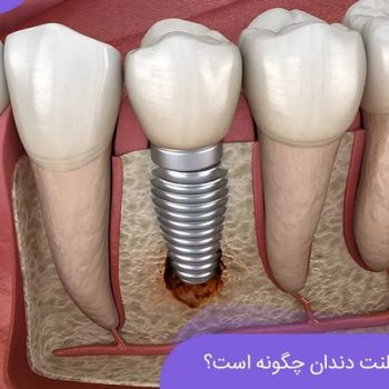 عفونت ایمپلنت دندان چگونه است