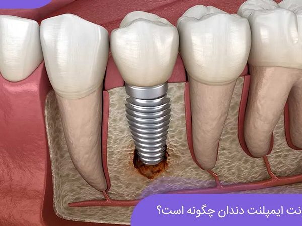 عفونت ایمپلنت دندان چگونه است