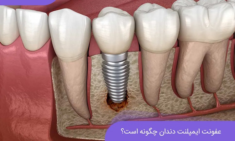 عفونت ایمپلنت دندان چگونه است