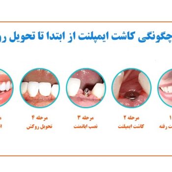 هزینه ایمپلنت دندان چقدر می باشد