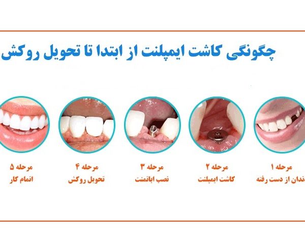 هزینه ایمپلنت دندان چقدر می باشد