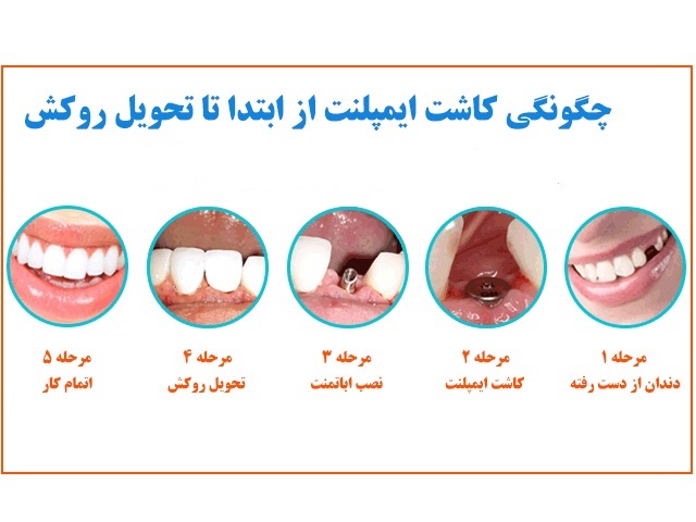 هزینه ایمپلنت دندان چقدر می باشد