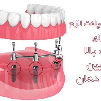 قیمت ایمپلنت کامل دهان چقدر است