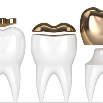 قیمت روکش دندان طلا چقدر است