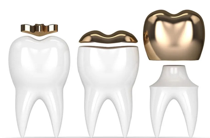 قیمت روکش دندان طلا چقدر است