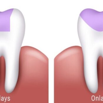 توصیه دندانپزشک در مورد اینله و انله دندان