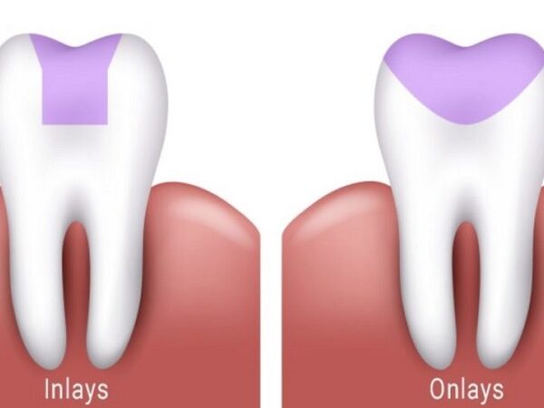 توصیه دندانپزشک در مورد اینله و انله دندان