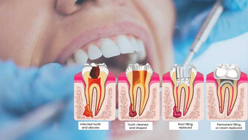 چه زمانی ریشه دندان نیاز به درمان و جراحی دارد