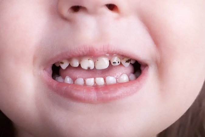 چه عواملی باعث پوسیدگی دندان کودکان میشود