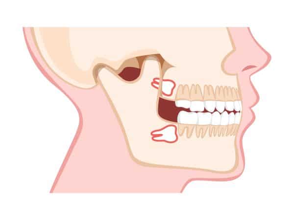 نهفتگی دندان عقل چه مشکلاتی بوجود می آورد
